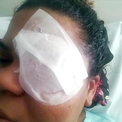Mulher perde a visão de um olho após ser agredida pelo namorado em Paulínia