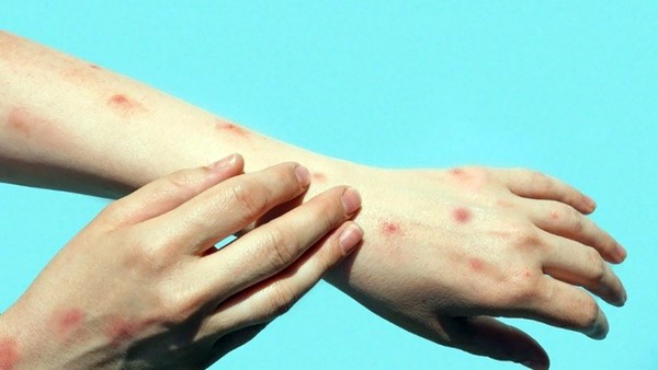 Sumaré registra 1º caso de monkeypox e Vigilância Sanitária alerta população